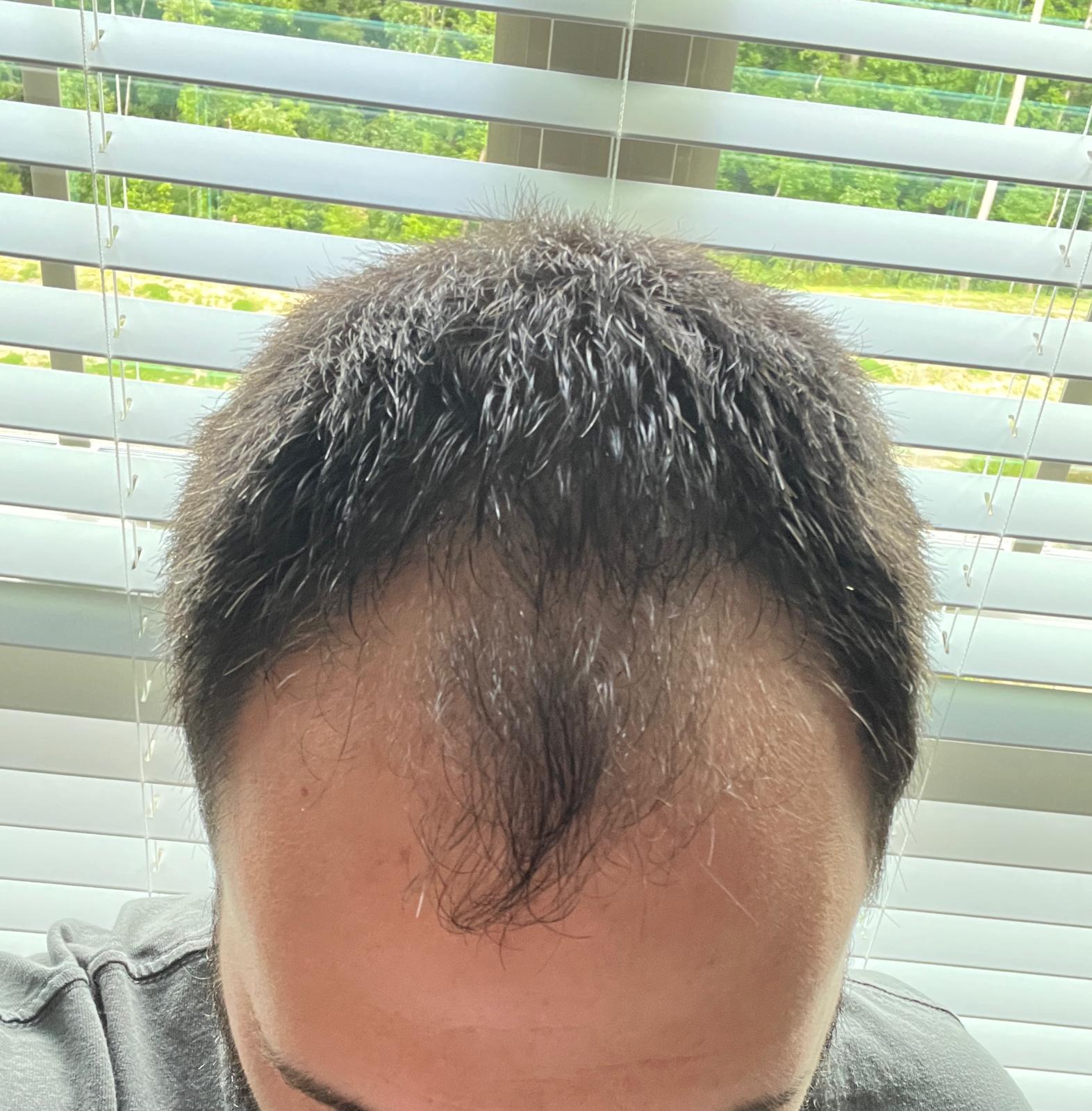 My hairline from the front, an hour after the first session, serum still in the hair